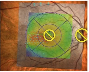 NAVILAS FOCAL LASER 